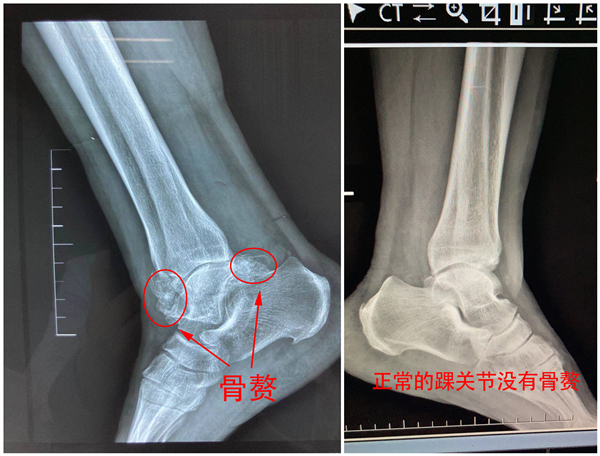 崴腳2.jpg